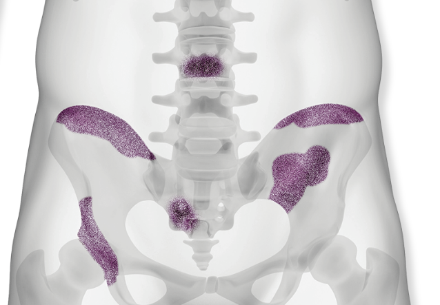 Pelvic bone and spine with purple highlights Graphic of pelvic bone and spine with spots highlighted in purple