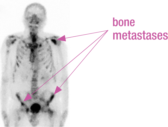 bone scan