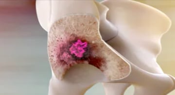 Xofigo® works at the site of bone metastases